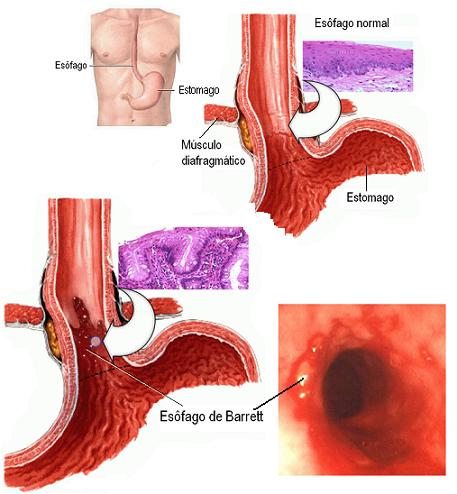 esofago de barrett